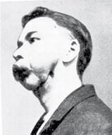 Image of man suffering with Phossy Jaw 